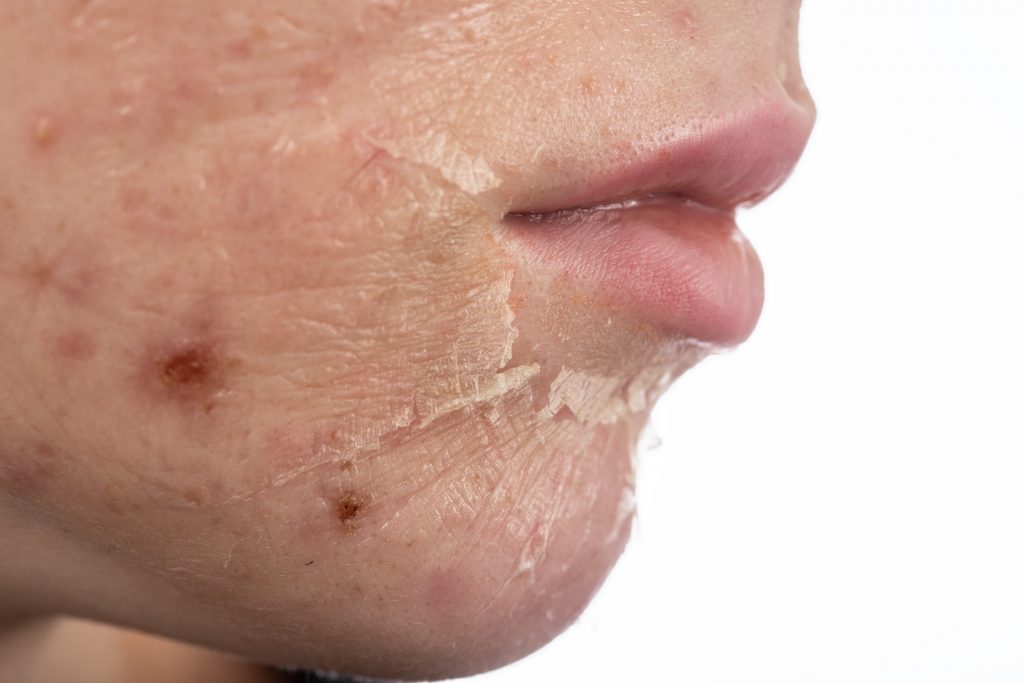 Acne Scar Reduction Dr Jon Yong Aesthetic Clinic