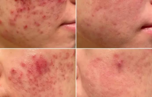 acne scar removal Singapore