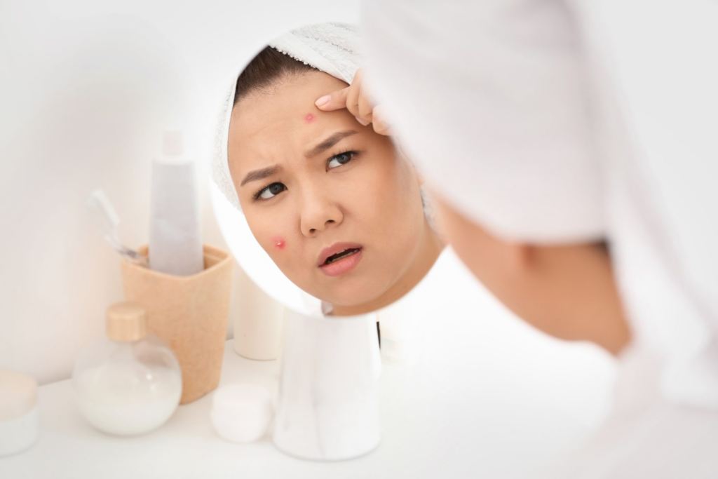 best acne treatment Singapore