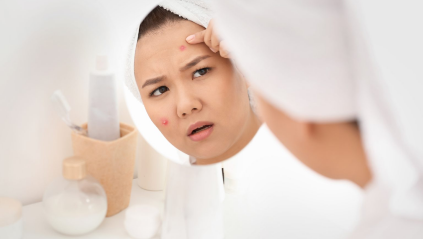 best acne treatment Singapore