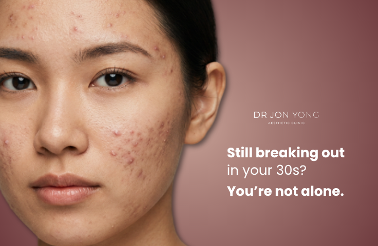 Acne Treatment Singapore
